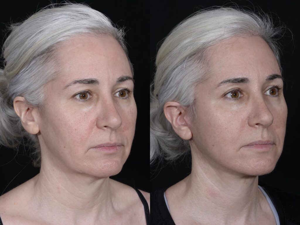 Deep Plane Facelift