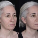 Deep Plane Facelift